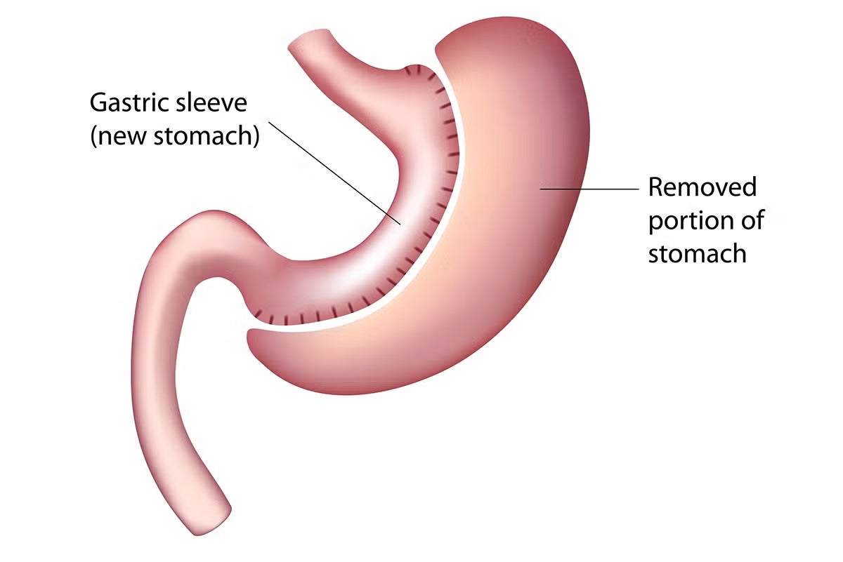 Vertical Sleeve Gastrectomy