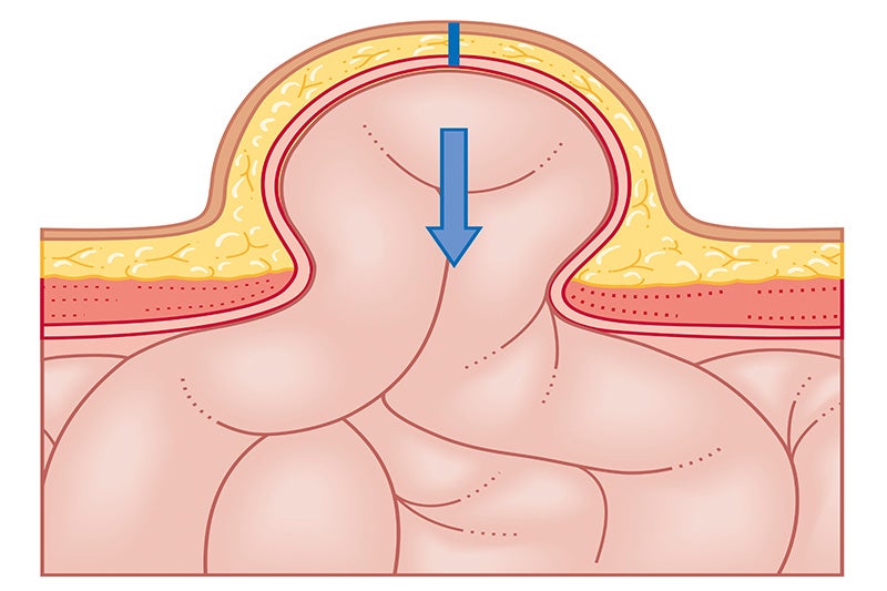What is a Hernia?